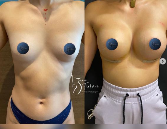 breast-augmentation